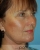 Fotorejuvenace – laserové omlazení pleti