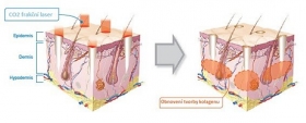 CO2 frakční resurfacing – absolutní a trvalé vyhlazení vrásek